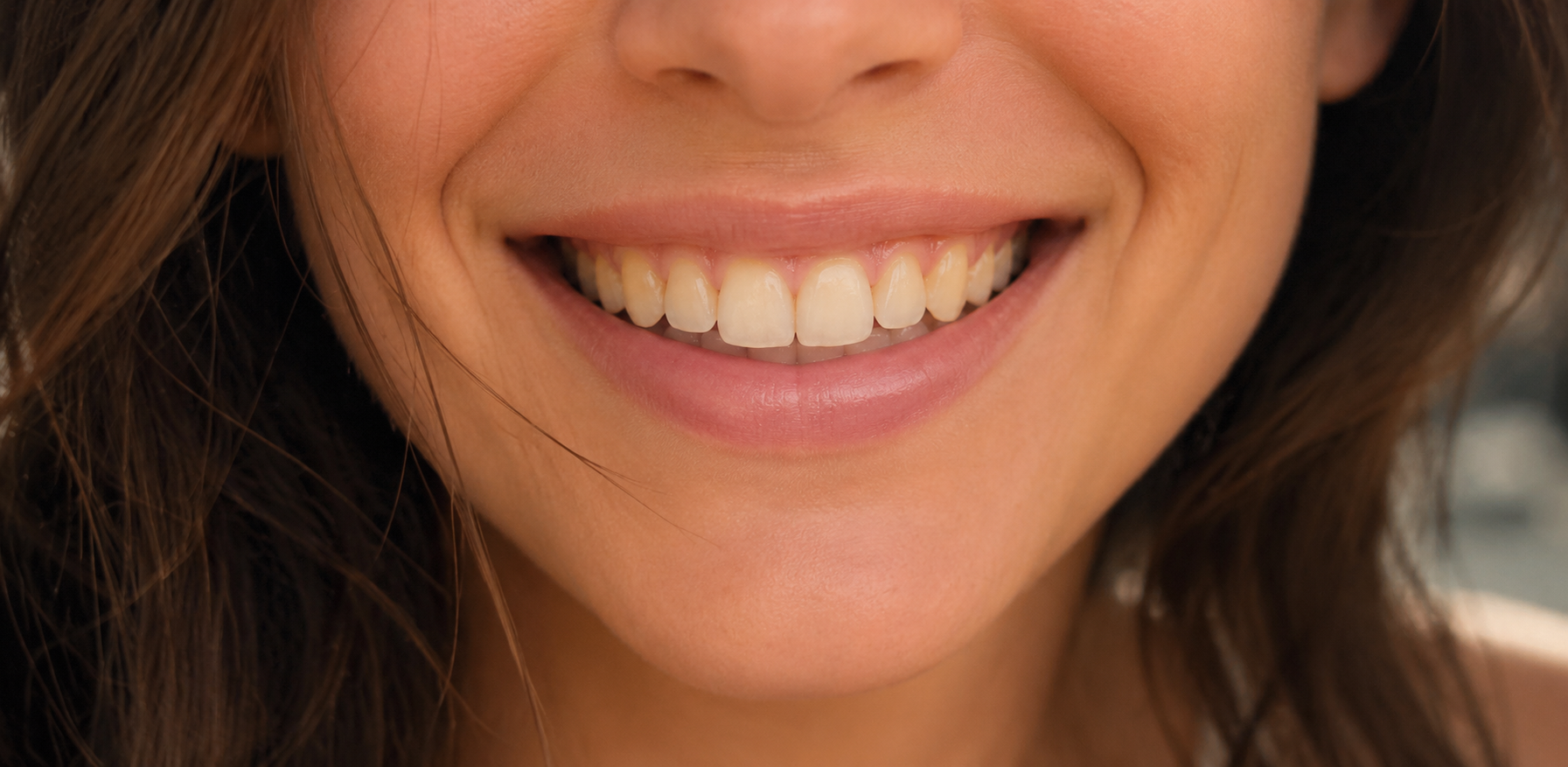 The same smile before cosmetic treatment, shown for comparison